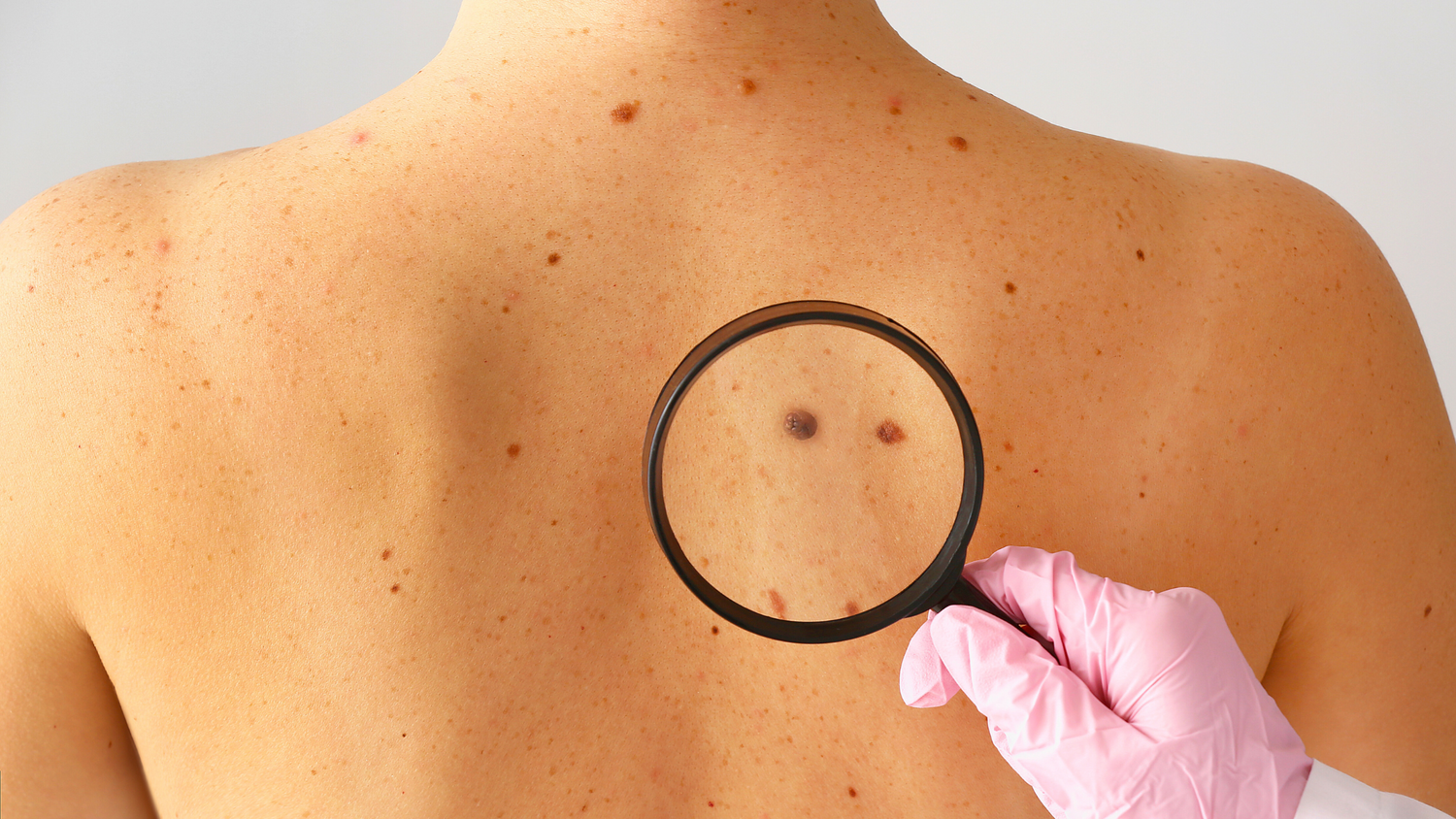Protect Your Skin from Melanoma: The Importance of Sunscreen