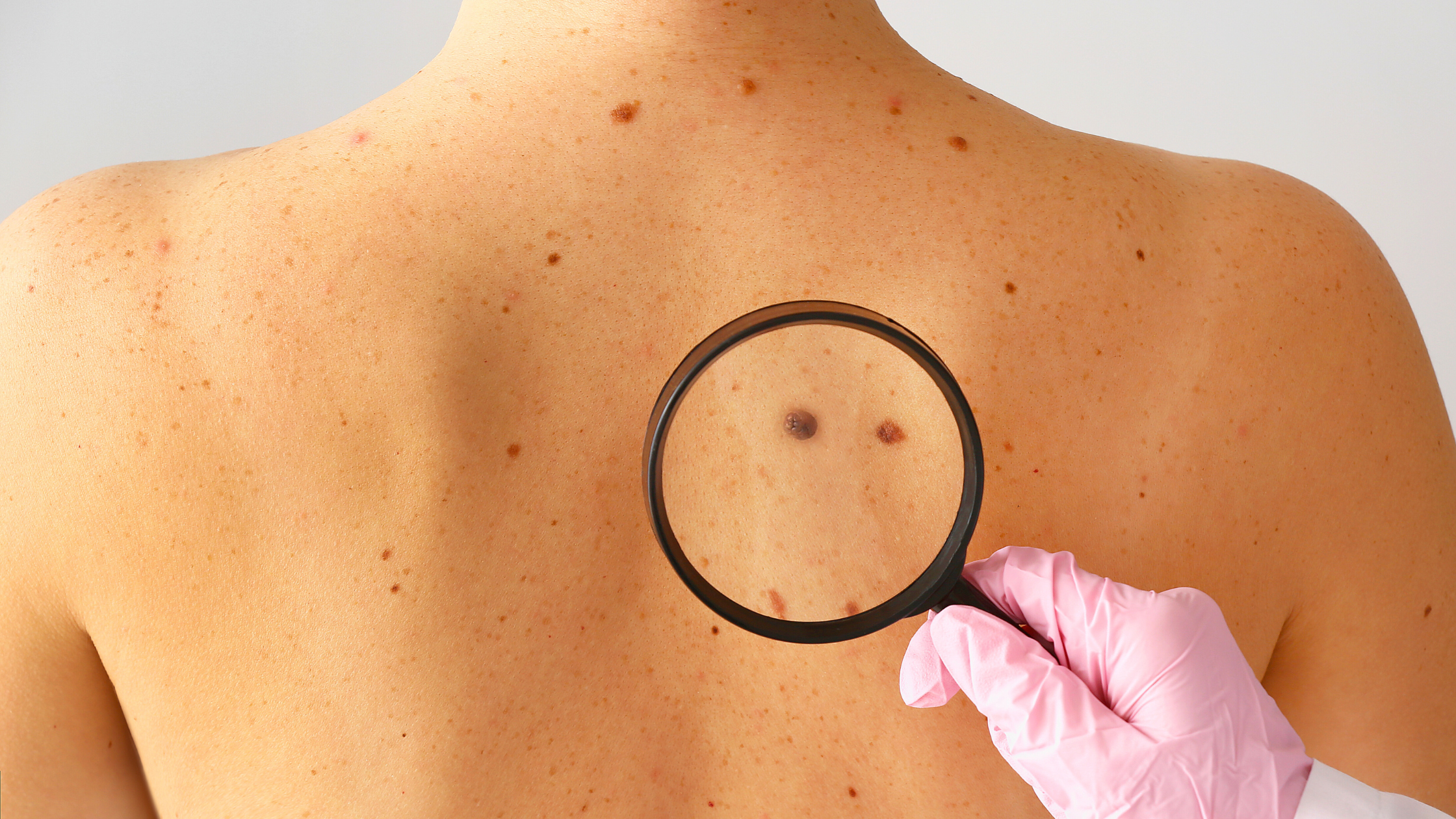 Protect Your Skin from Melanoma: The Importance of Sunscreen